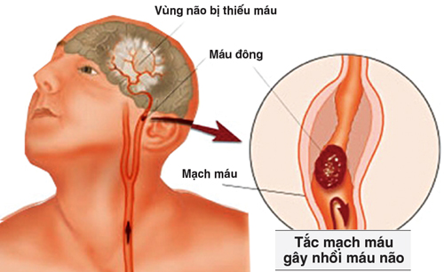 nhồi máu não là gì